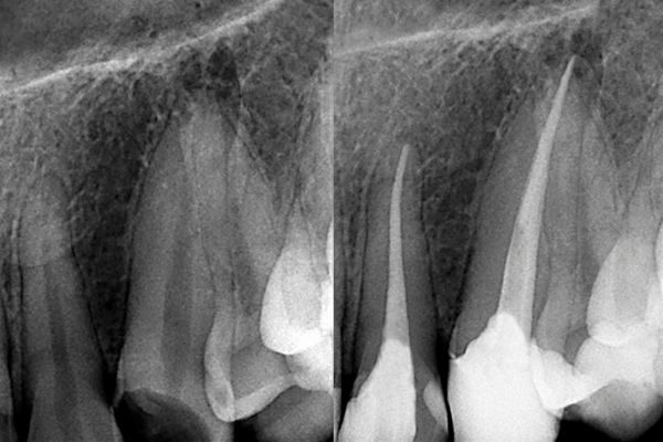 endodoncia