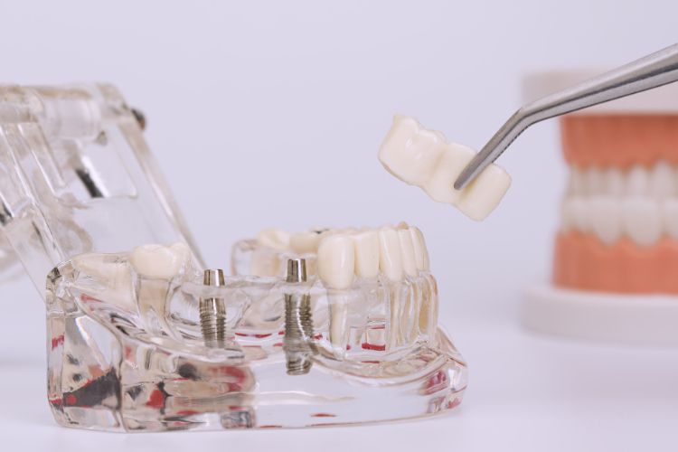 implantes dentales y ortodoncia